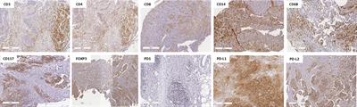 Prognostic Influence of Residual Tumor-Infiltrating Lymphocyte Subtype After Neoadjuvant Chemotherapy in Triple-Negative Breast Cancer